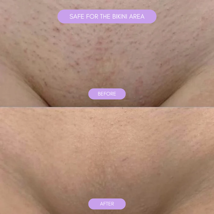 Hair Removal Device for Smooth Skin Noxord