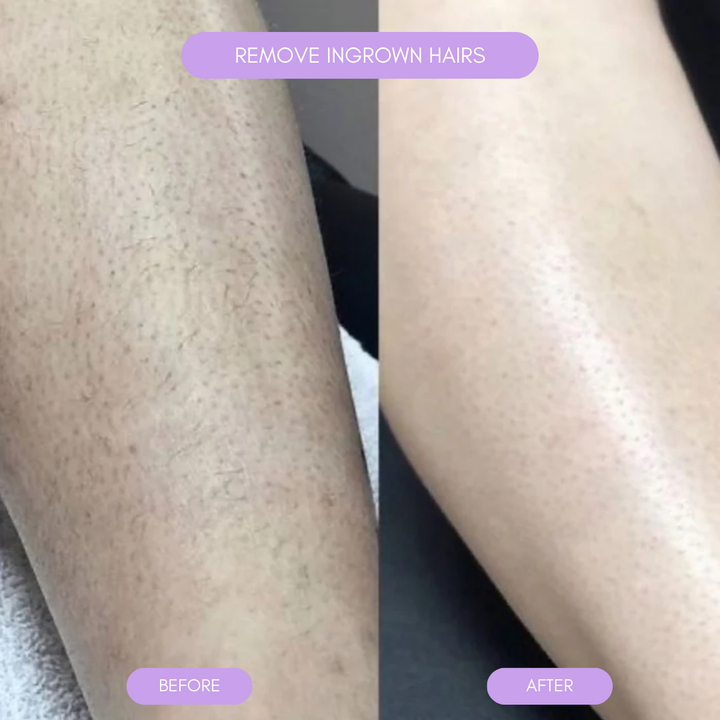 Hair Removal Device for Smooth Skin Noxord