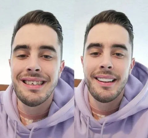 Instant Smile Veneers (Upper & Lower Set)