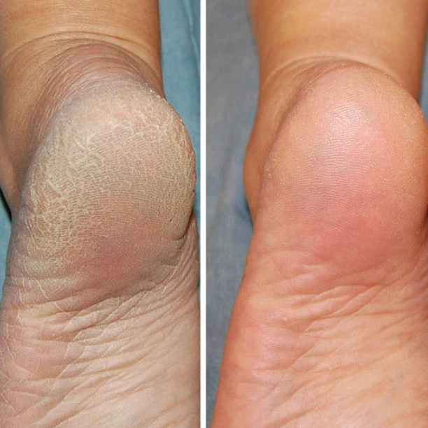 Noxord | Silicon-Spa-Socks - Intensive care for cracked and tired feet