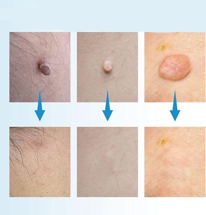 Kalsten | Skin spot remover for warts & skin tags