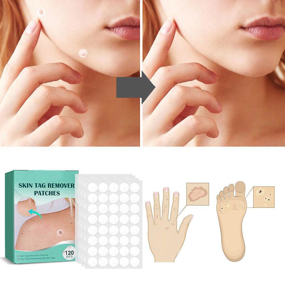 SkinClear - Patch for the removal of spots and warts Kalsten
