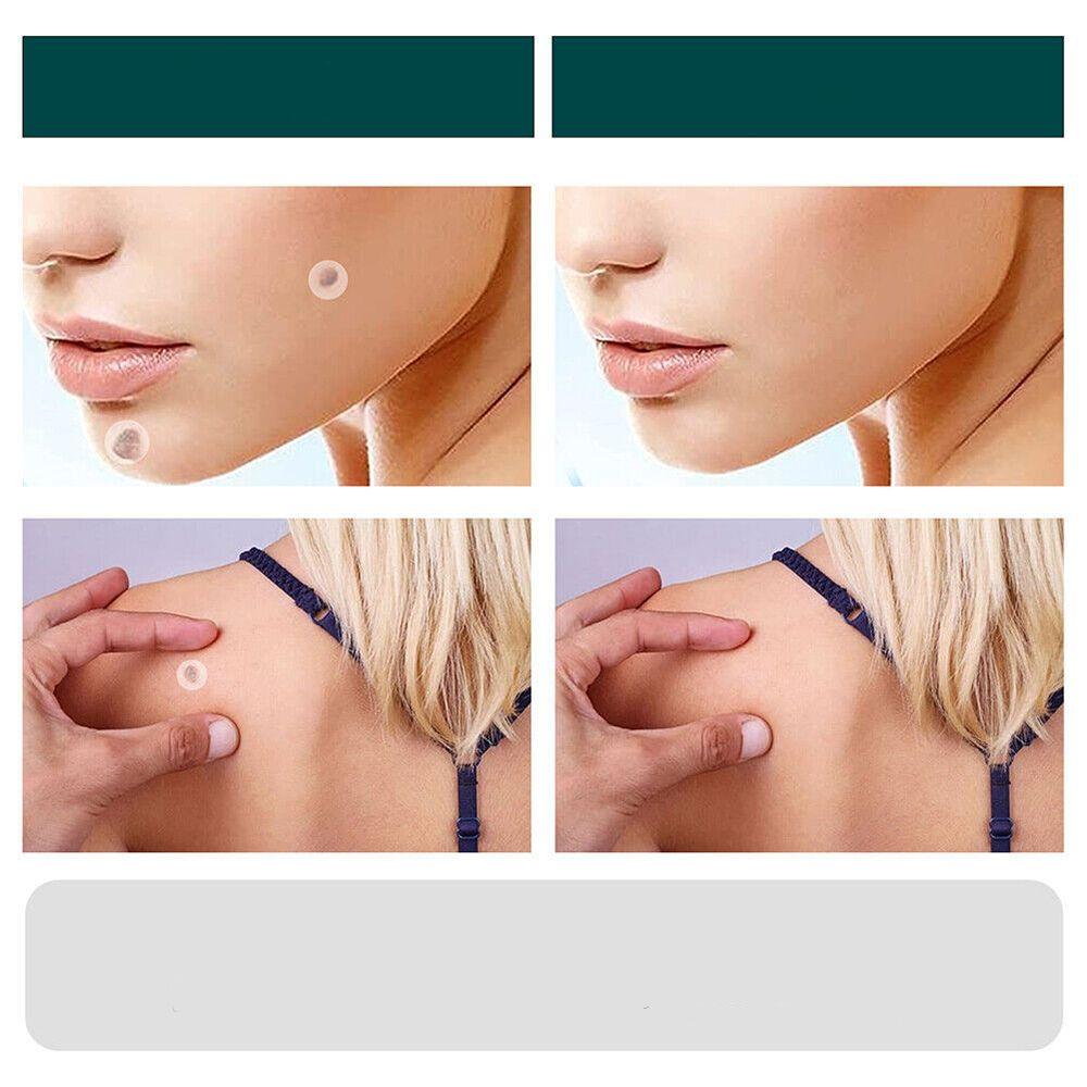 SkinClear - Patch for the removal of spots and warts Kalsten
