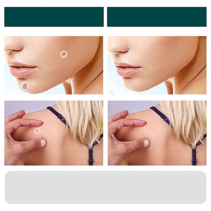 SkinClear - Patch for the removal of spots and warts Kalsten