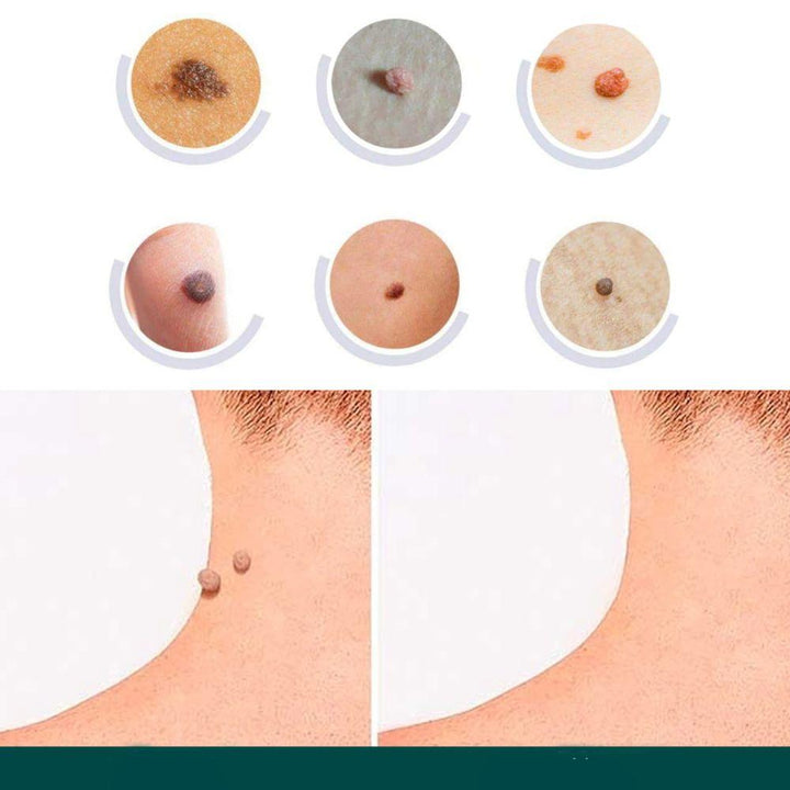 SkinClear - Patch for the removal of spots and warts Kalsten