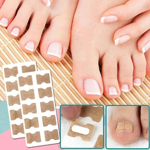 ALIGNSTRIP Painless Ingrown Nail Correction Strips