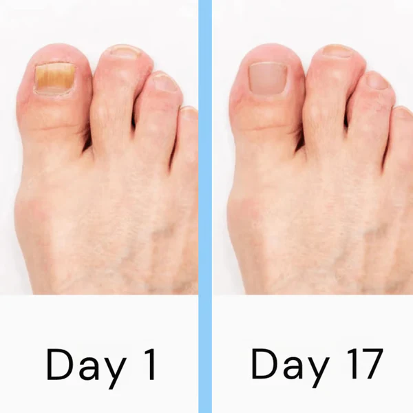Noxord | Nail Laser Fungus Device