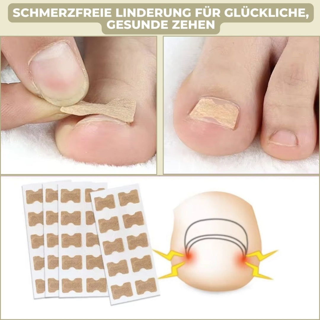 ALIGNSTRIP Painless Ingrown Nail Correction Strips
