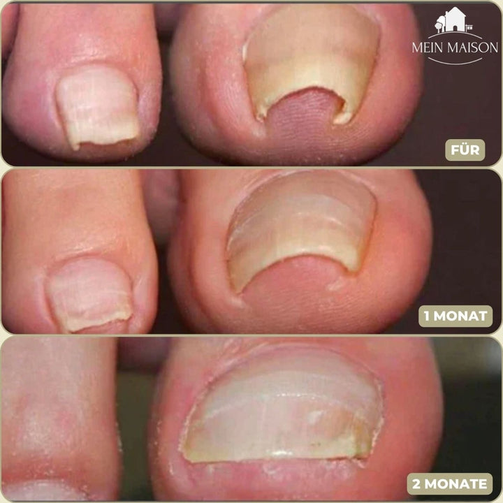 Kalsten | ALIGNSTRIP – Painless Nail Correction Strips for Ingrown & Deformed Nails