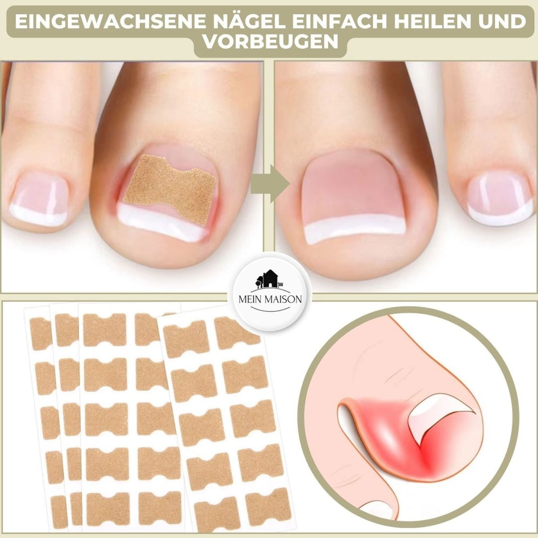 Kalsten | ALIGNSTRIP – Painless Nail Correction Strips for Ingrown & Deformed Nails