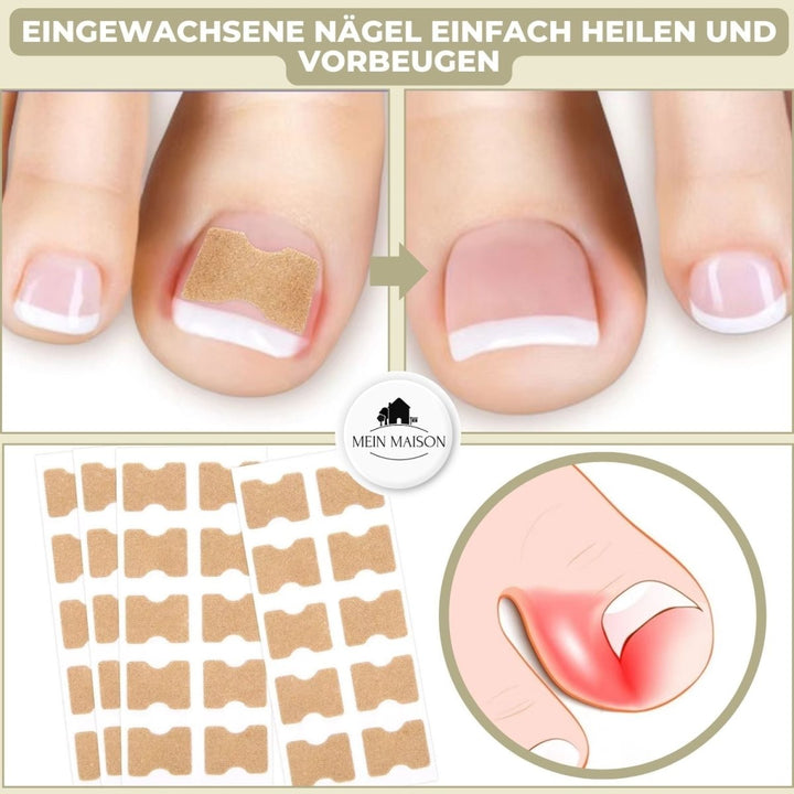 Kalsten | ALIGNSTRIP – Painless Nail Correction Strips for Ingrown & Deformed Nails