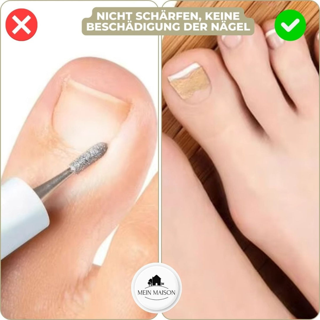 ALIGNSTRIP Painless Ingrown Nail Correction Strips