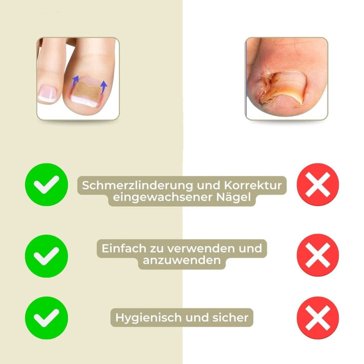 Kalsten | ALIGNSTRIP – Painless Nail Correction Strips for Ingrown & Deformed Nails
